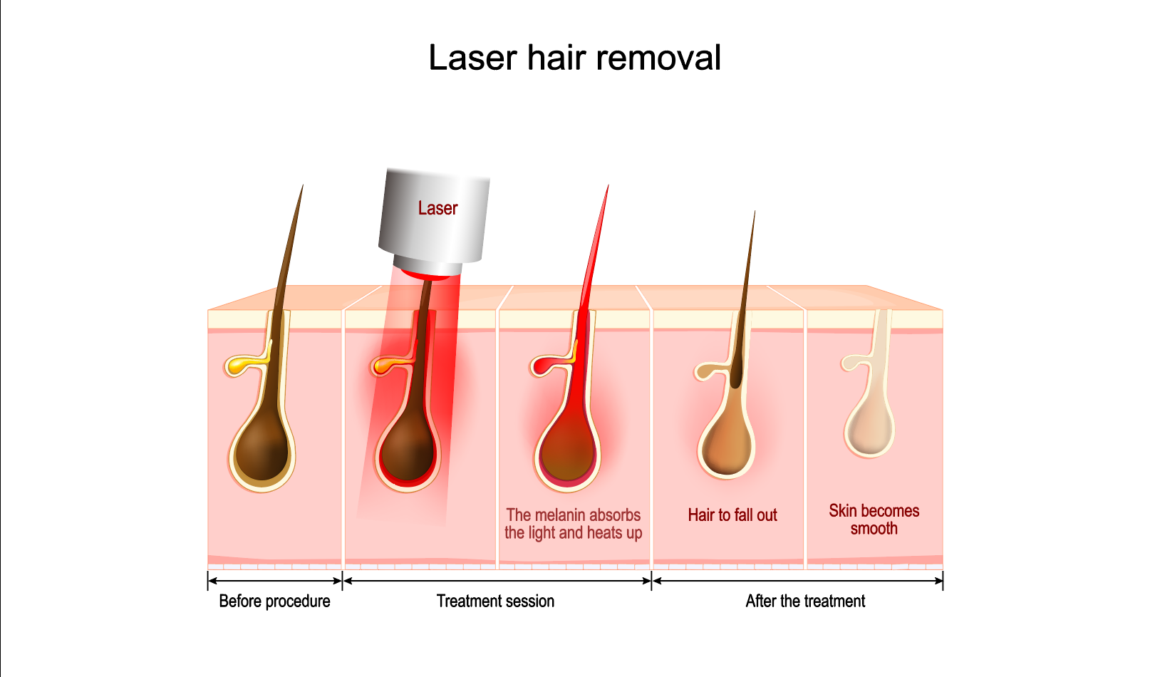 Does diode laser hair removal work? --Explore the origin of hair