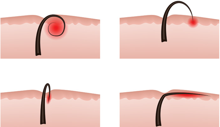 What is diode laser hair removal?