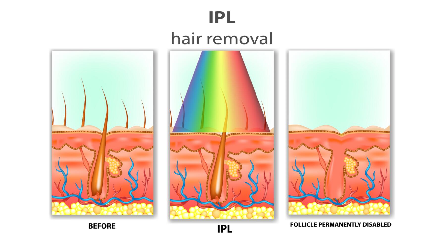 Why add IPL for your clinic ?