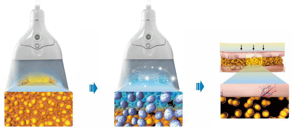 Cryolipolysis Slimming Device 360°C Cooling Tech 01