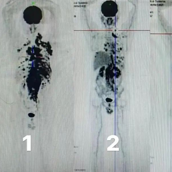 Mr. D----CanadianDiagnosis: Diffuse Large B-cell Lymphoma (DLBCL) with TP53 mutation