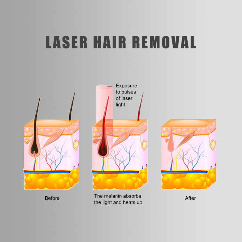 Diode Laser Hair Removal (3)sdg