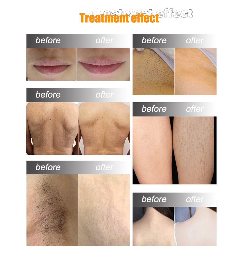 Diode Laser Hair Removal (9)ydz