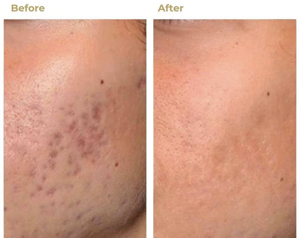 CO2 laser skin acne remova