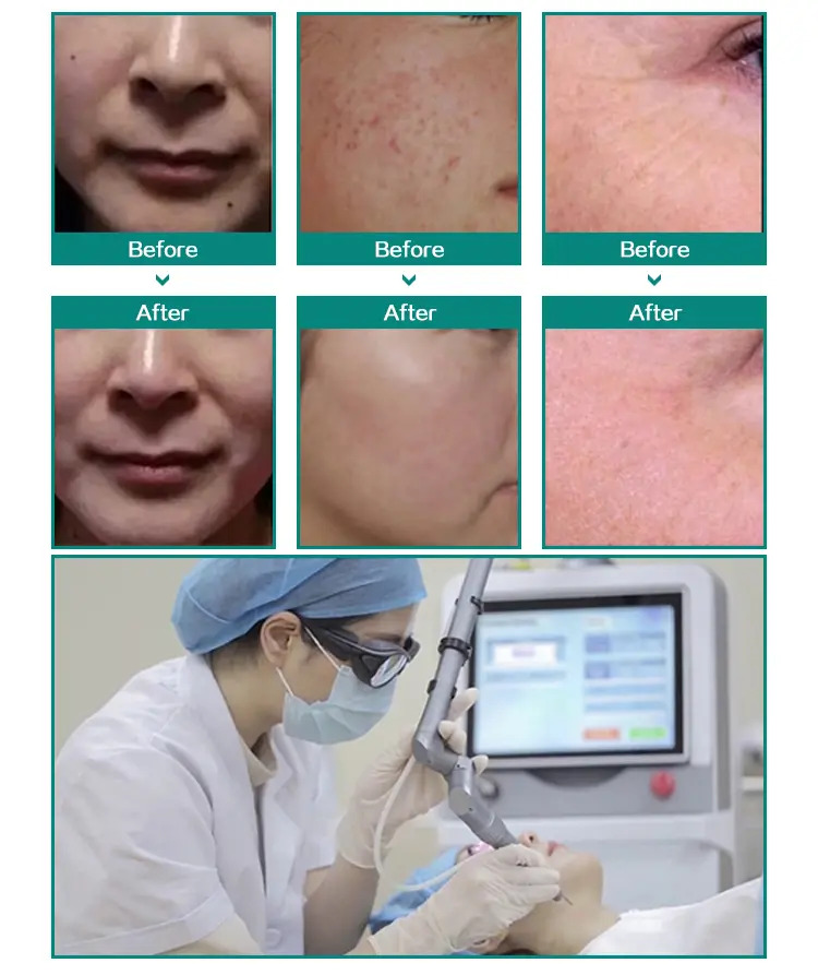 Resurfaçage de la peau au laser Co2