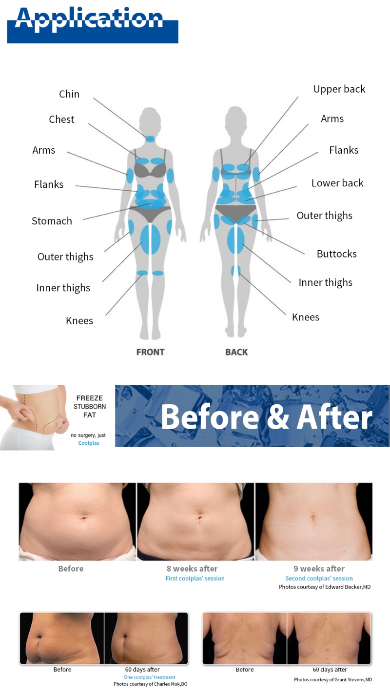Cryotherapy fat removal