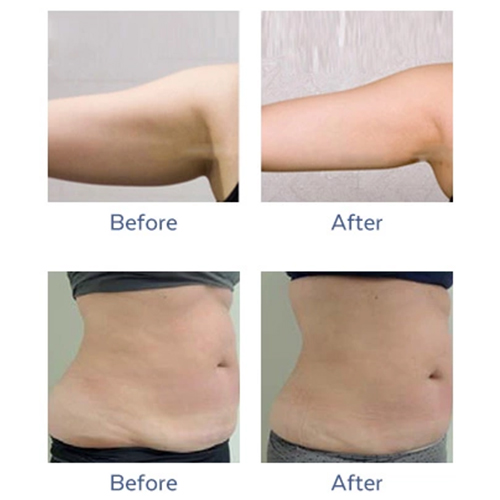 Thermal Shape (Reduce Cellulite And Reshape Body) [Nagoya
