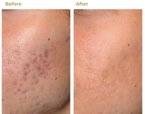 fractional co2 laser acne removal