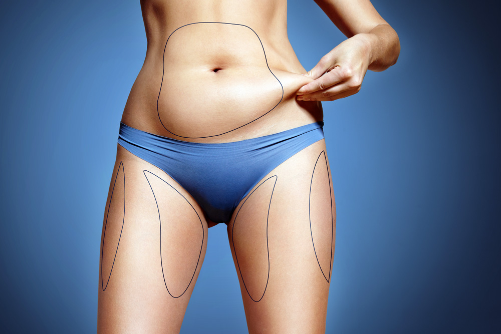 Soğuk Lipoliz ile İnatçı Yağlara Elveda Deyin: Serin Tedavi Liposuction Rehberiniz