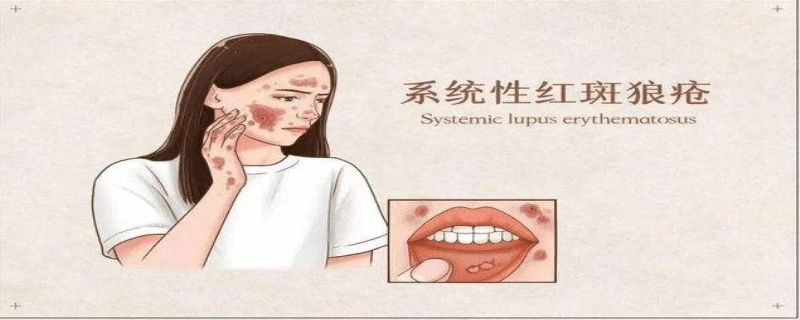 Systemic Lupus Erythematosusw0c