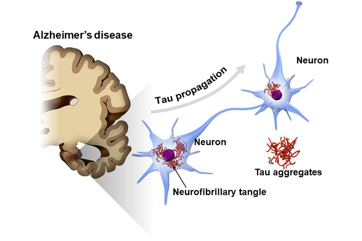 Комплексный подход к лечению болезни Альцгеймера