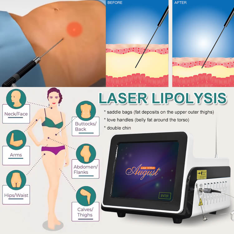 Le processus clinique de la lipolyse au laser