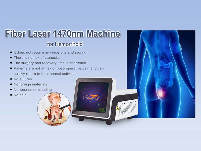 Hemorrhoid laser procedure (LHP)