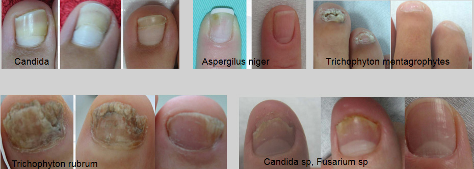 nail fungus laser (1)81a