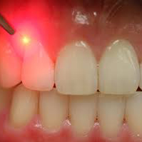 لیزر دندانپزشکی (1)rpo