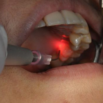 стоматологический лазер (6)8oj
