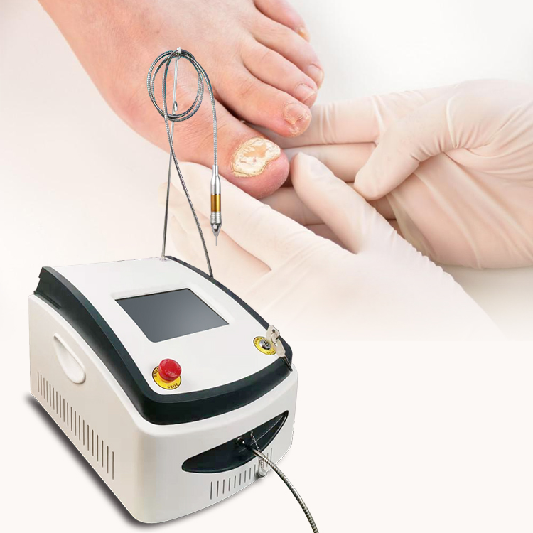 980nm Diode Laser for Nail Fungus Treatment